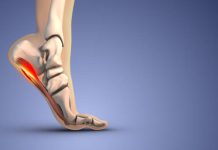 The Warning Patterns Foot Specialists Notice in Advanced Plantar Fasciitis early plantar fasciitis