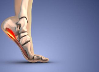 The Warning Patterns Foot Specialists Notice in Advanced Plantar Fasciitis early plantar fasciitis