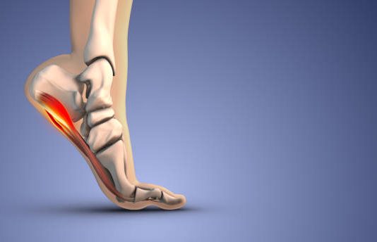 The Warning Patterns Foot Specialists Notice in Advanced Plantar Fasciitis early plantar fasciitis