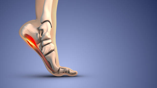 early plantar fasciitis early plantar fasciitis